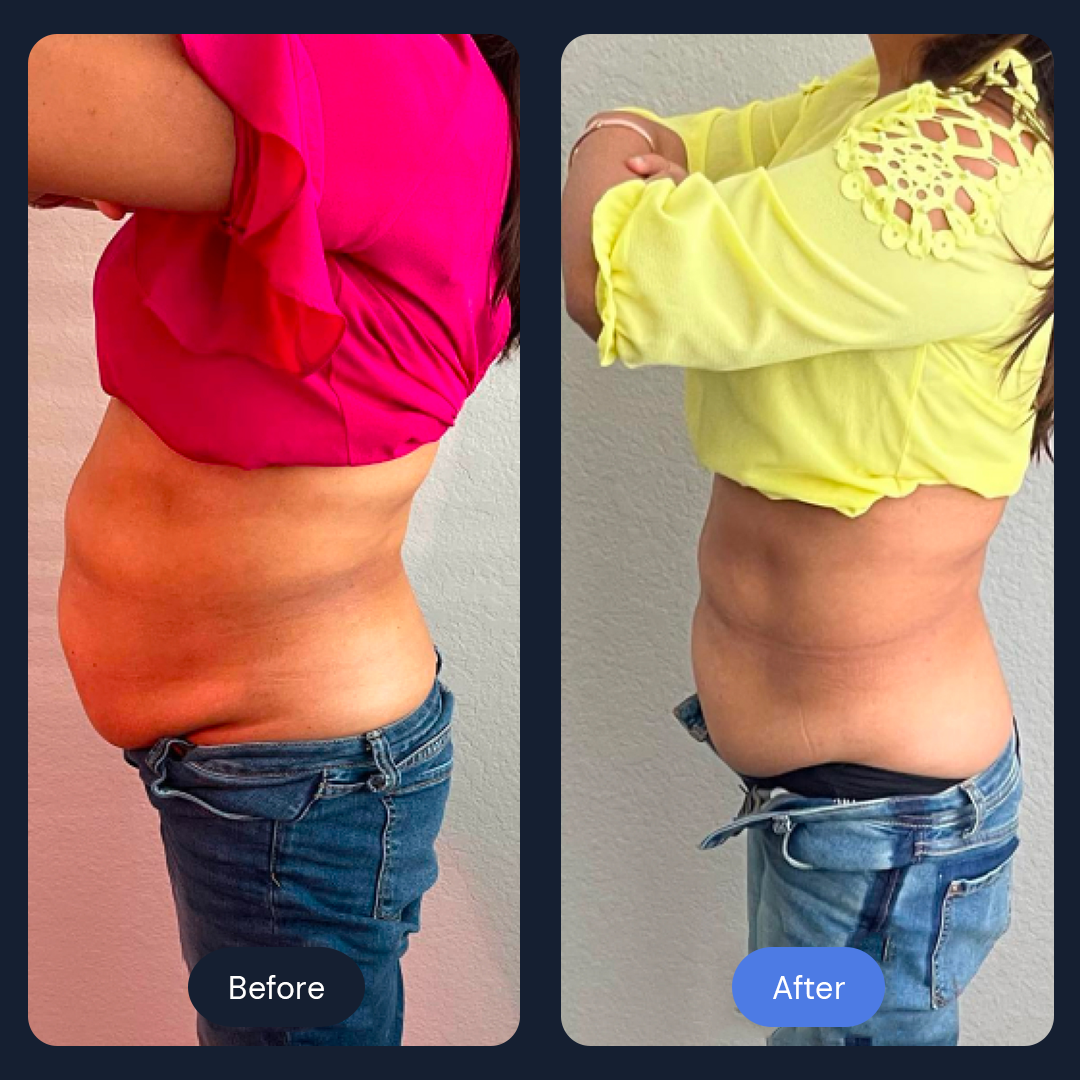 Cryo Sculpt | Targeted Body Contouring with Cold Therapy