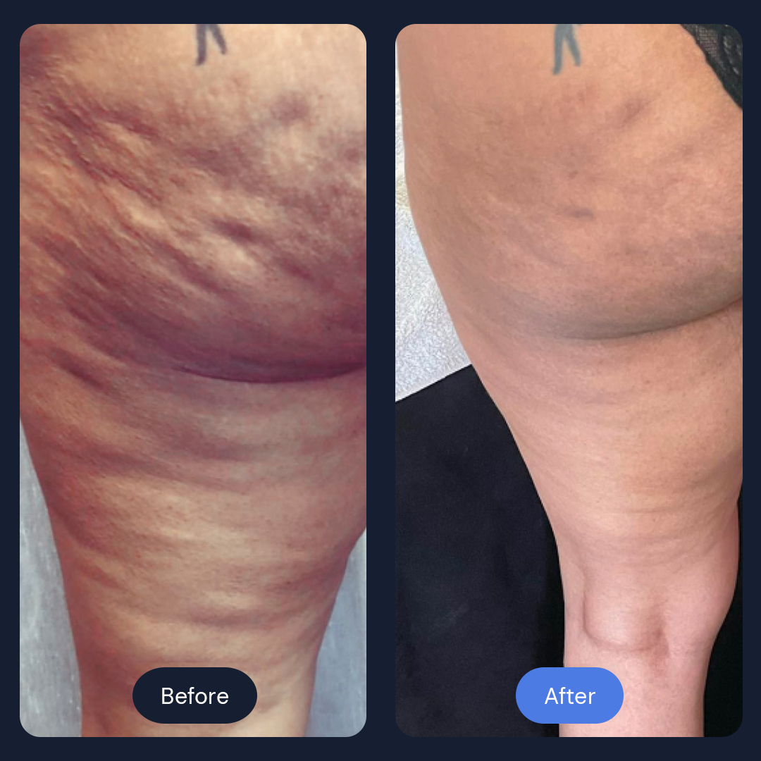 Cryo Sculpt | Targeted Body Contouring with Cold Therapy