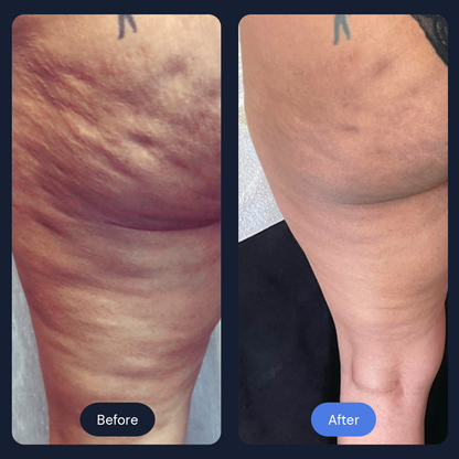 Cryo Sculpt | Targeted Body Contouring with Cold Therapy