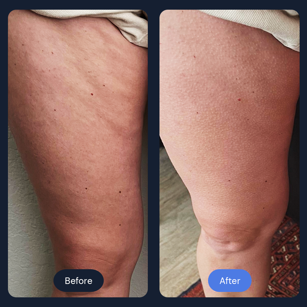 Cryo Sculpt | Targeted Body Contouring with Cold Therapy