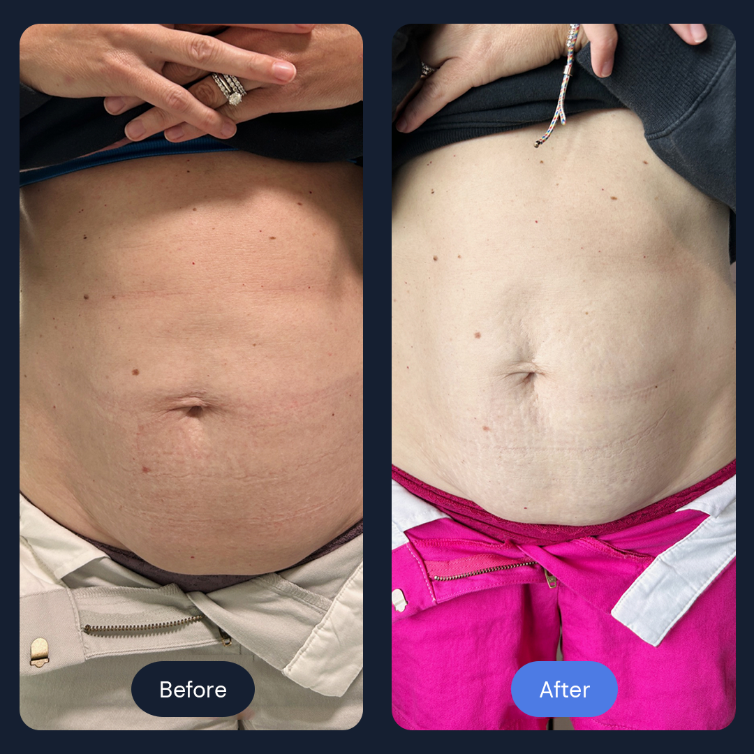 Cryo Sculpt | Targeted Body Contouring with Cold Therapy
