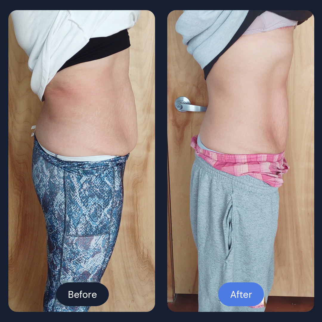 Cryo Sculpt | Targeted Body Contouring with Cold Therapy