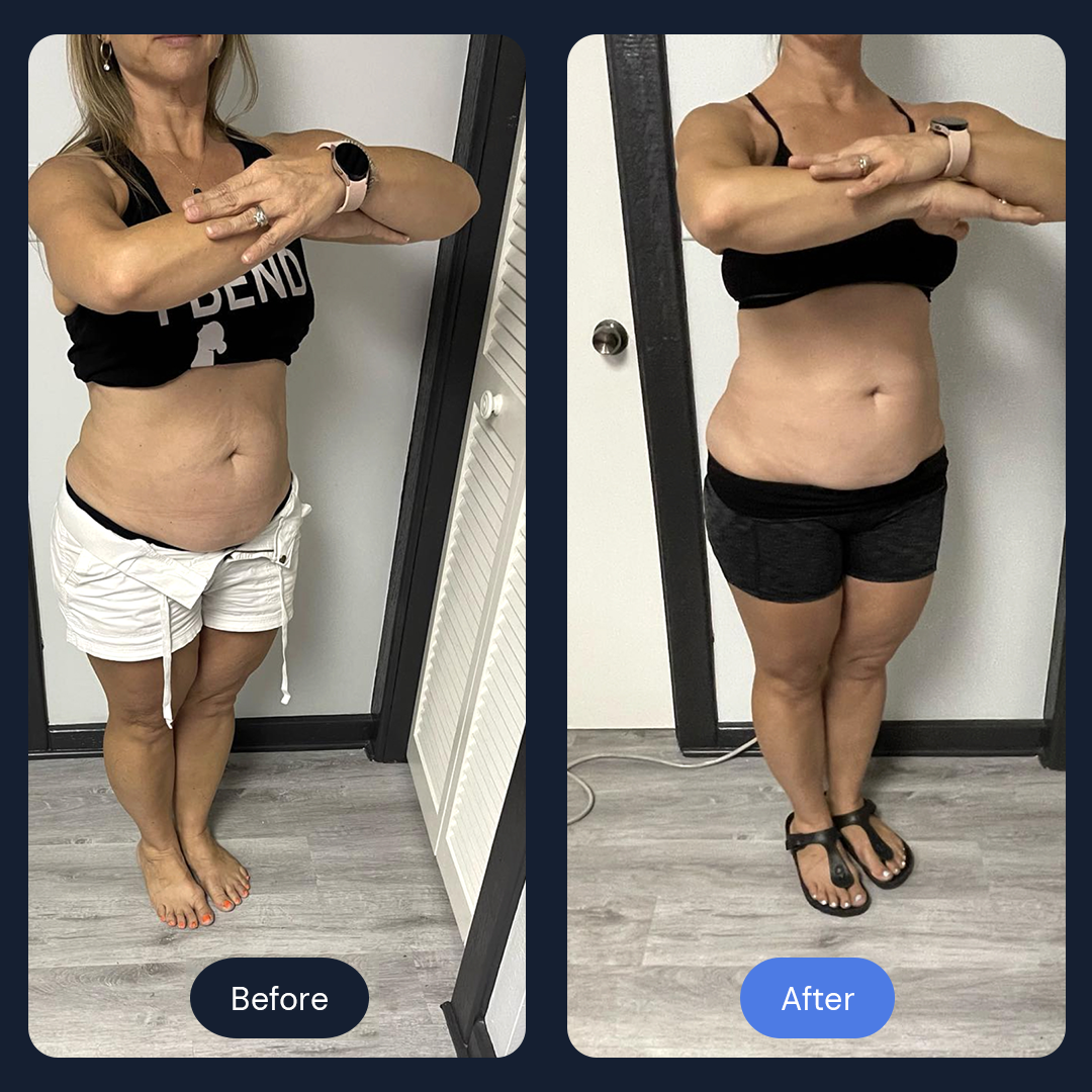 Cryo Sculpt | Targeted Body Contouring with Cold Therapy