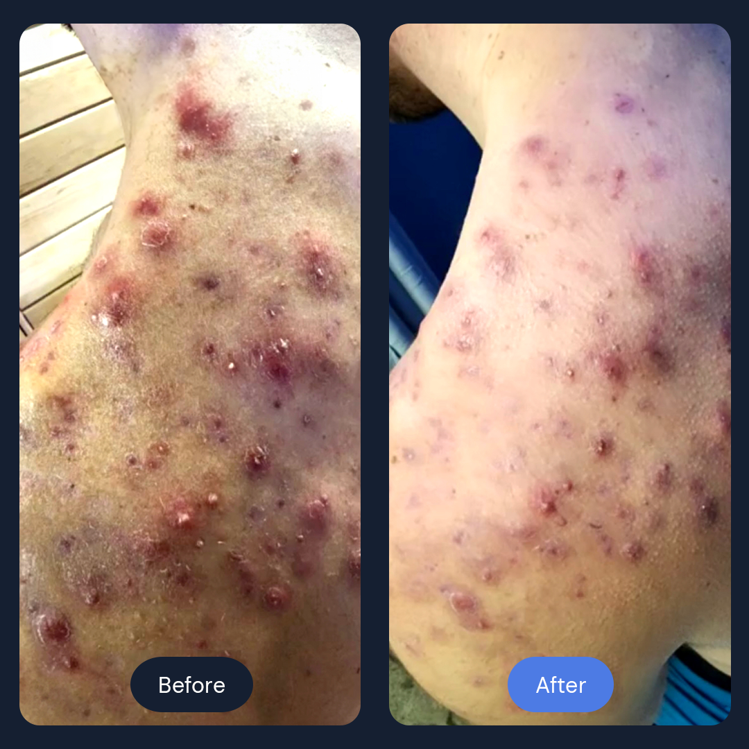 Cryo Acne Facial | Advanced Cold Therapy for Acne & Inflamed Skin