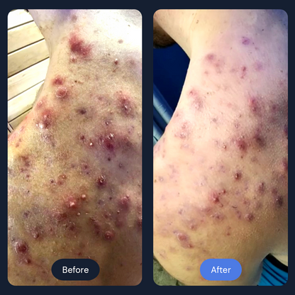 Cryo Acne Facial | Advanced Cold Therapy for Acne & Inflamed Skin