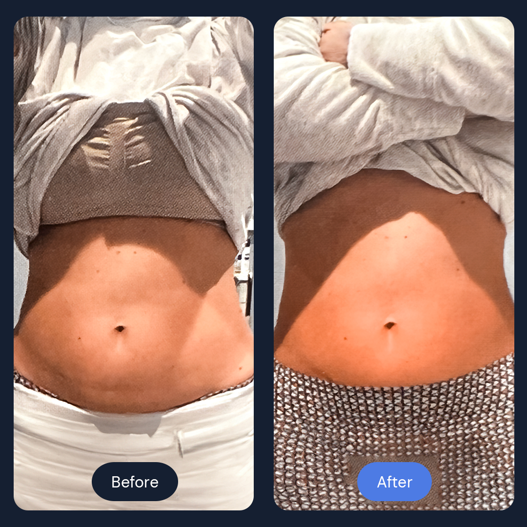 Cryo Sculpt | Targeted Body Contouring with Cold Therapy