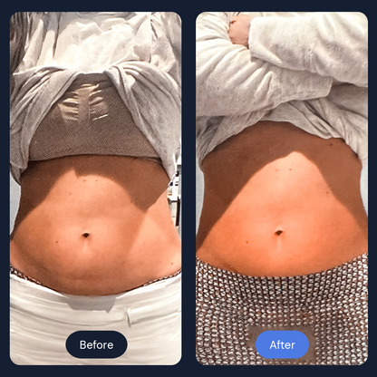 Cryo Sculpt | Targeted Body Contouring with Cold Therapy