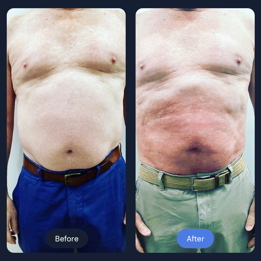 Cryo Sculpt | Targeted Body Contouring with Cold Therapy