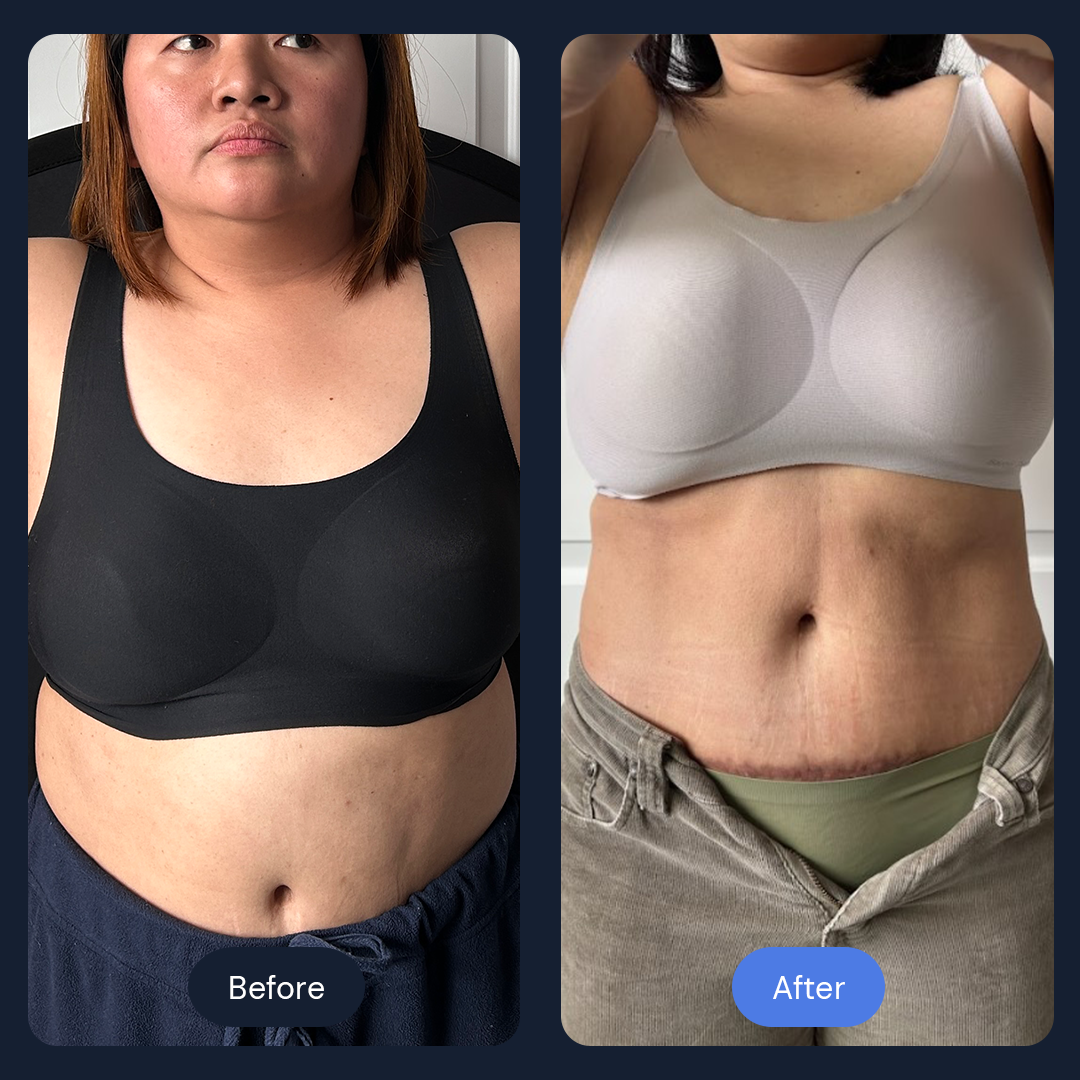 Cryo Sculpt | Targeted Body Contouring with Cold Therapy