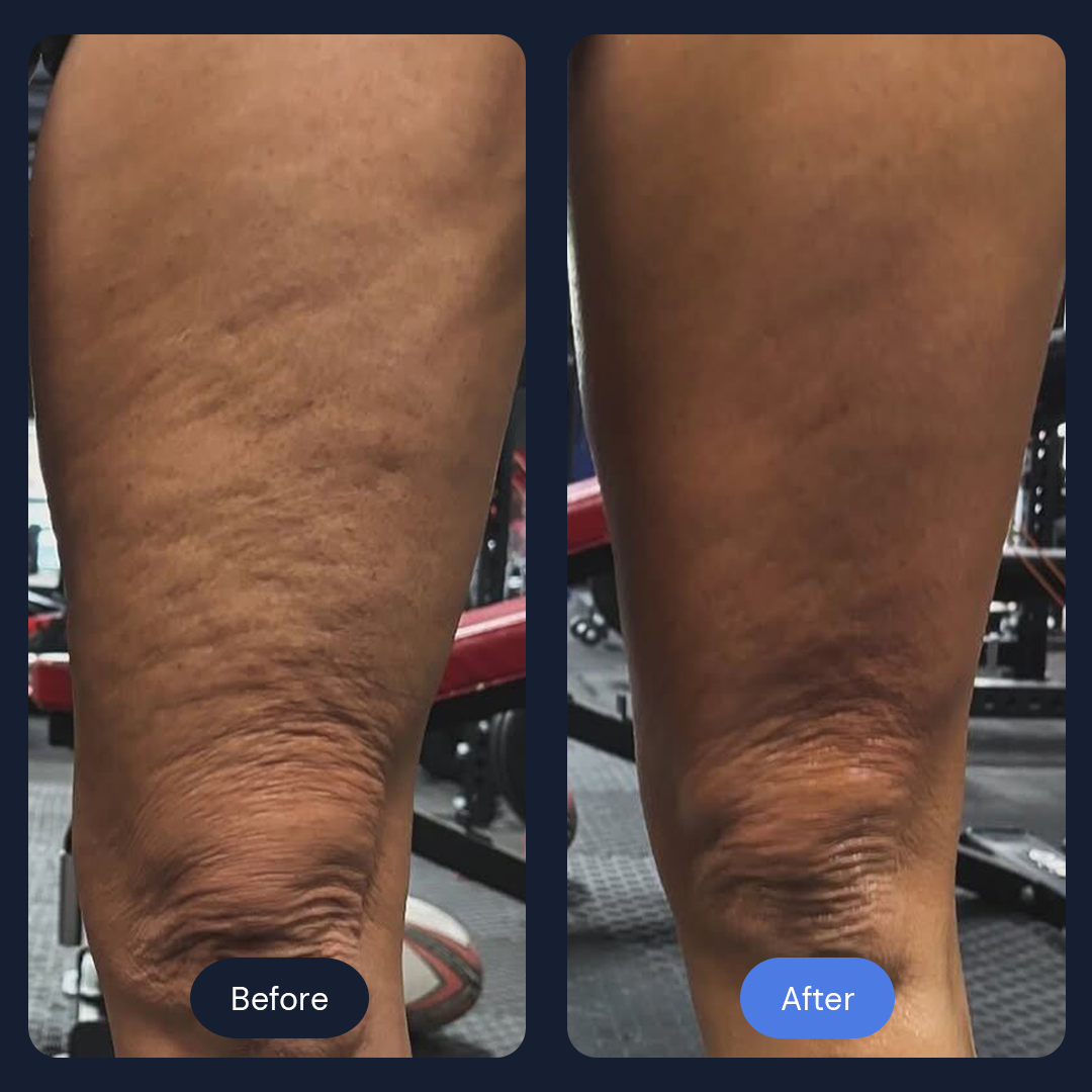 Cryo Sculpt | Targeted Body Contouring with Cold Therapy