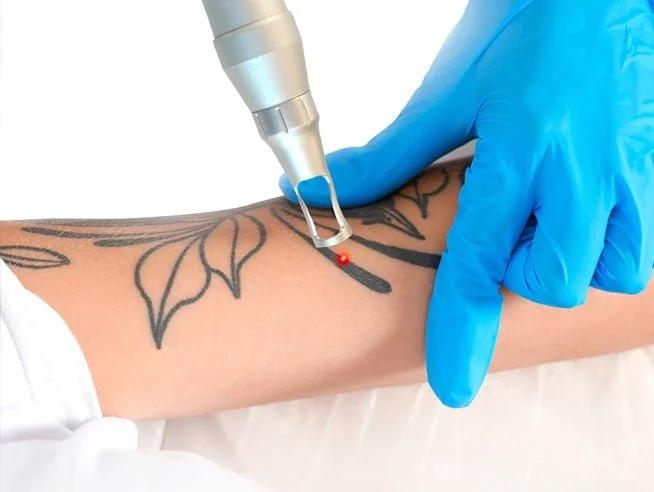 Picosecond Laser Tattoo Removal